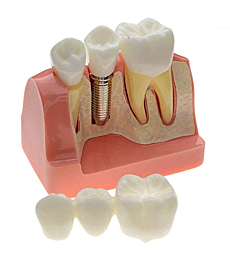 1 PCS Dental Model Implant Analysis Crown Bridge Demonstration Teeth Model for Education