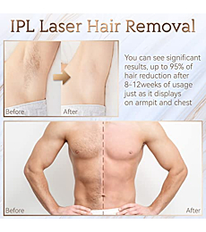 IPL Hair Removal, Laser Permanent Hair Removal for Women and Men, 999900 Flashes UPGRADED At-Home Hair Removal Device for Facial Legs Arms Whole Body Treatment