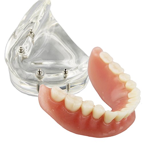Dental Model Overdenture Inferior 4 Implants