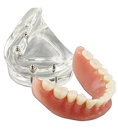 Dental Model Overdenture Inferior 4 Implants