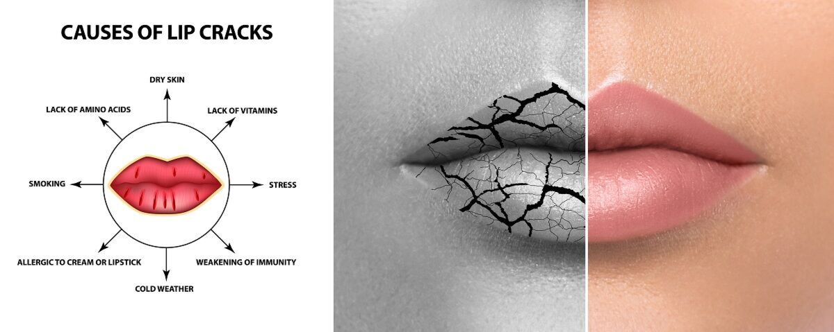 Causes of Lip Cracks Along With The Best Treatment Solutions